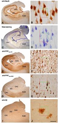 Subregional Density of Neurons, Neurofibrillary Tangles and Amyloid Plaques in the Hippocampus of Patients With Alzheimer’s Disease